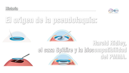 El origen de la pseudofaquia: Harold Ridley, el caza Spitfire y la biocompatibilidad del PMMA.